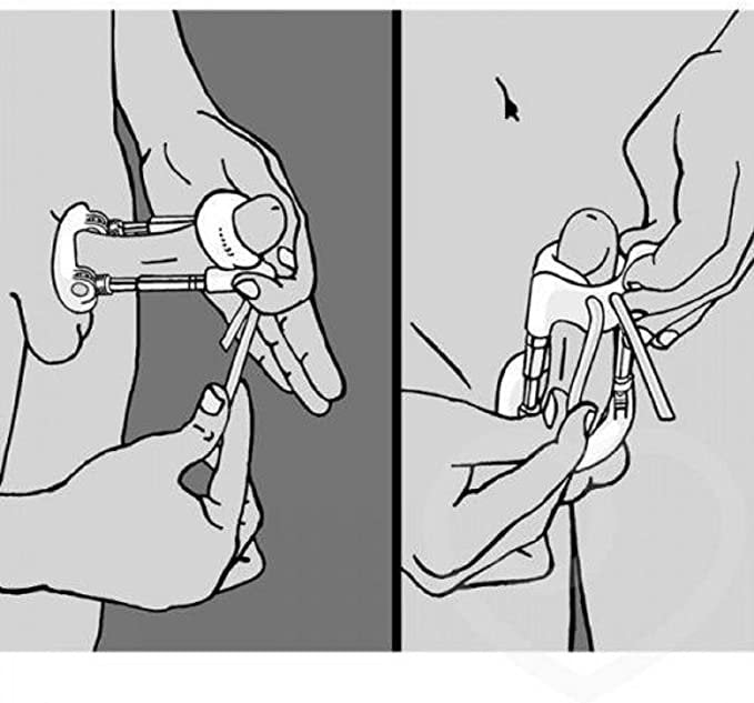 EXTENSOR DE PENE POR TRACCIÓN